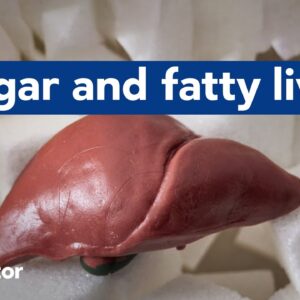 Reducing sugar improves fatty liver